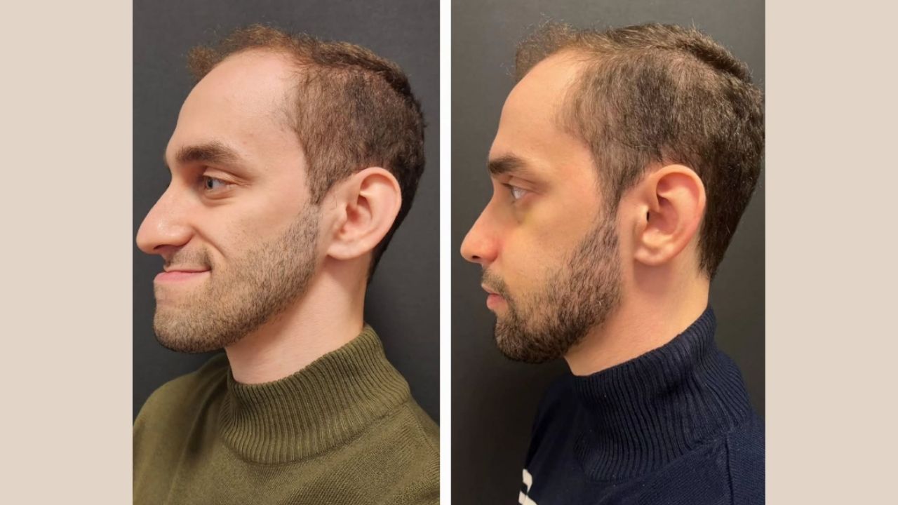 Ideal Candidates for Jawline and Facial Implants