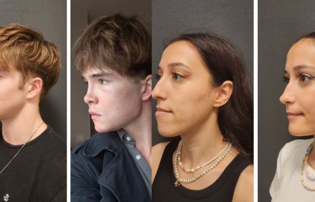 Jawline Implants and Facial Implants