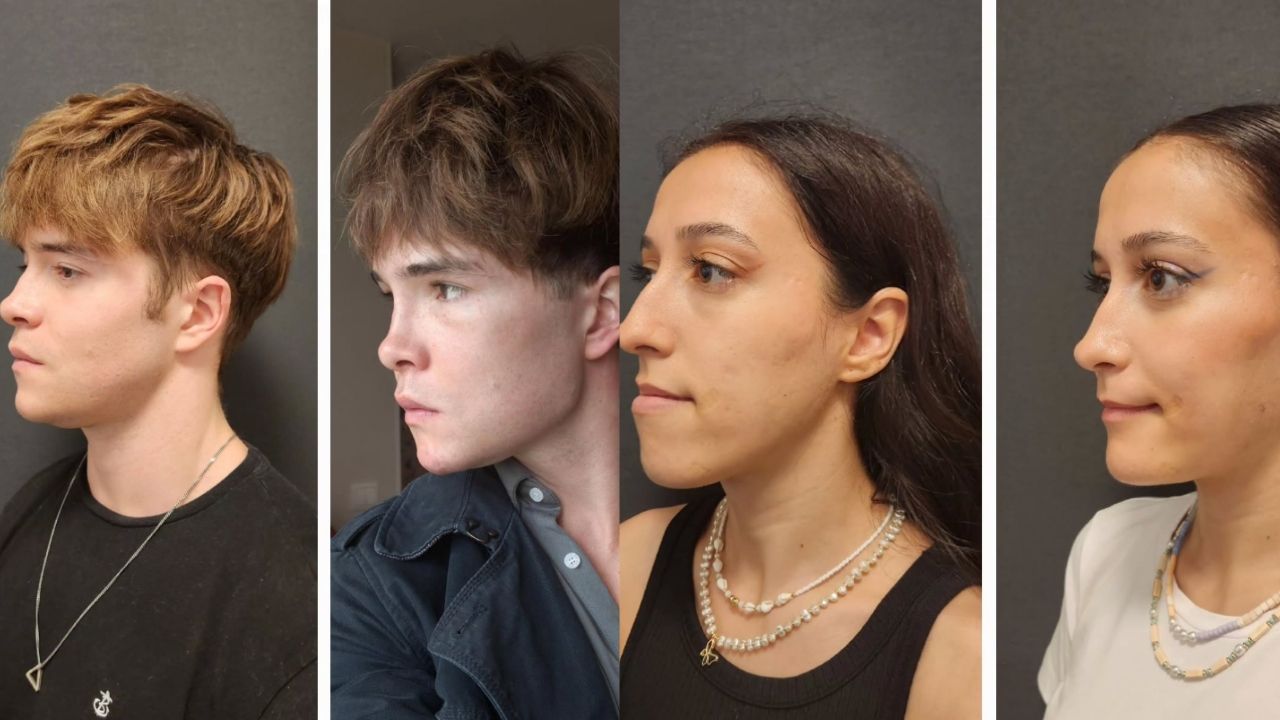 Jawline Implants and Facial Implants