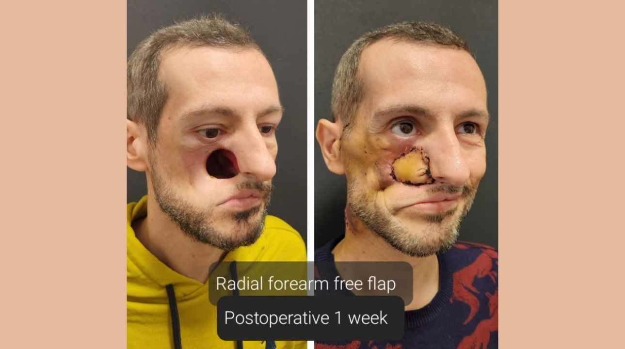 Benefits of Facial Implants