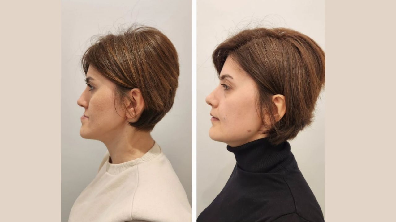 The Procedure and Recovery Time of the Jawline Implants