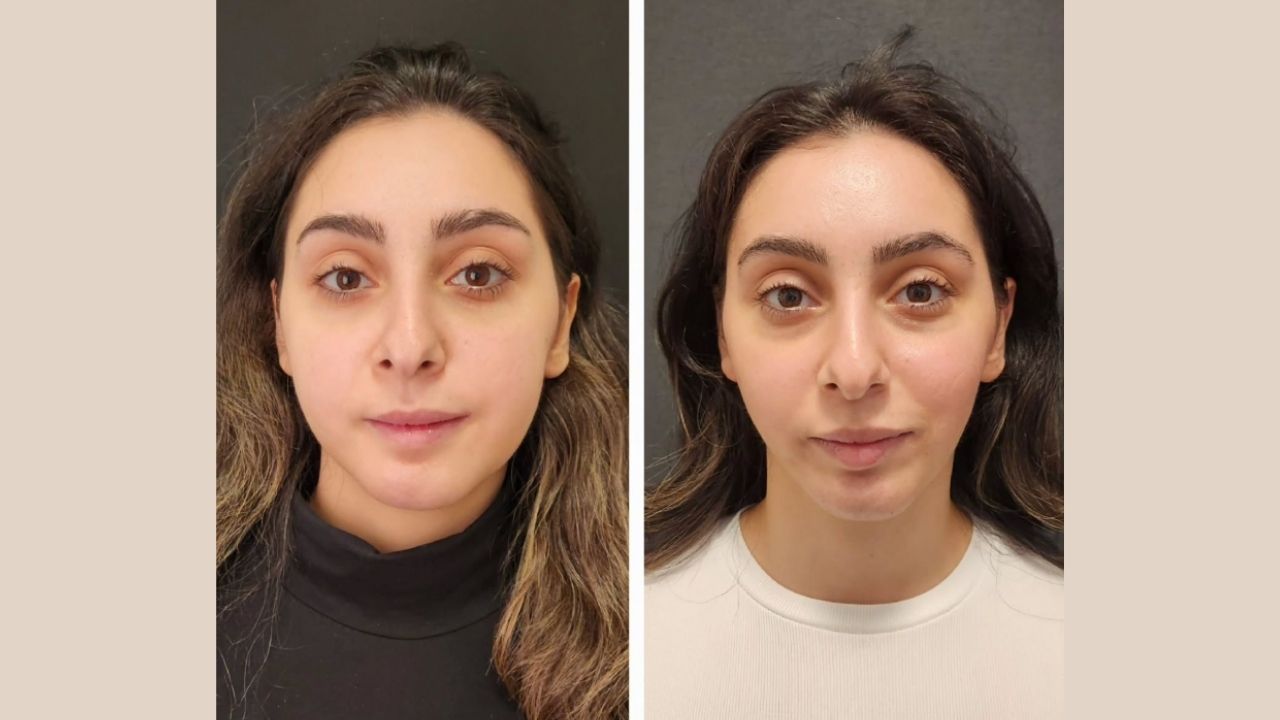 Titanium Facial Implants 2026 (Benefits, Risks & Cost) 