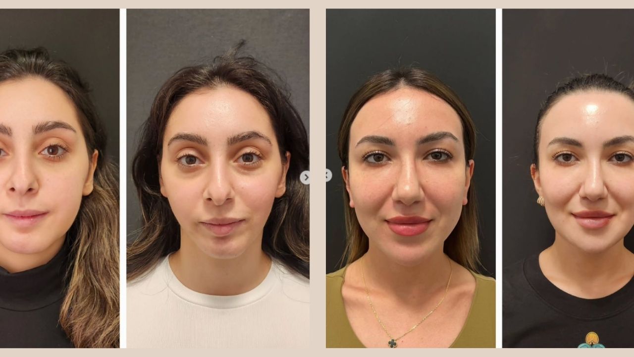 Titanium Facial Implants 2026 (Benefits, Risks & Cost)