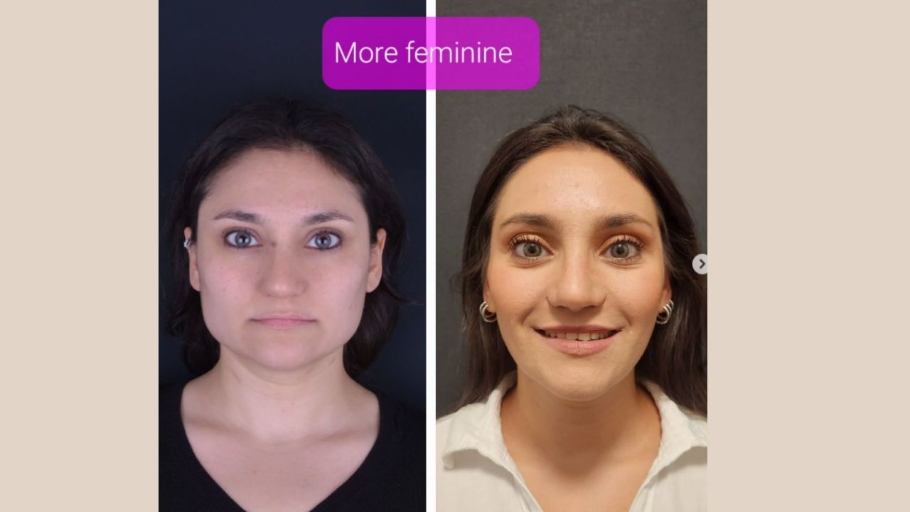 Titanium Facial Implants 2026 (Benefits, Risks & Cost)