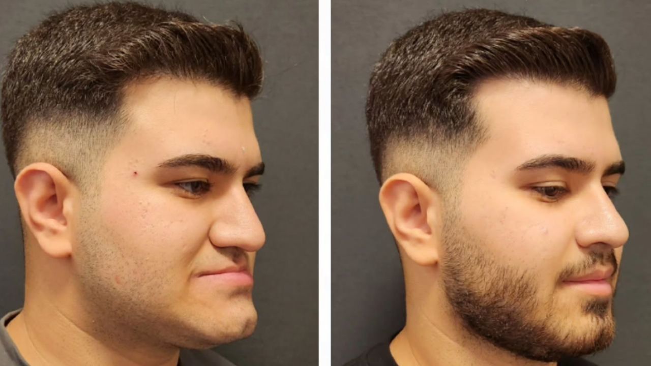 Frequently Asked Questions - Are Facial Implants Safe?