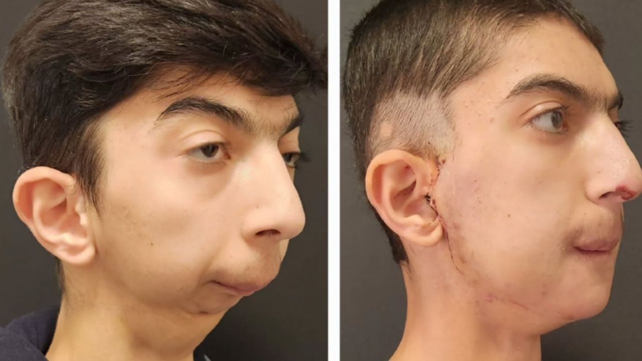 Frequently Asked Questions About TMJ Ankylosis Surgery