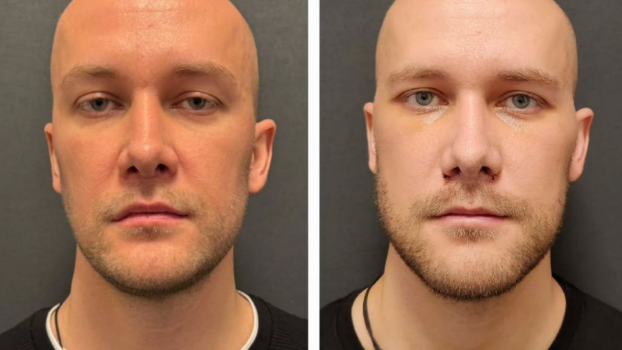 Frequently Asked Questions About Zygoma Augmentation