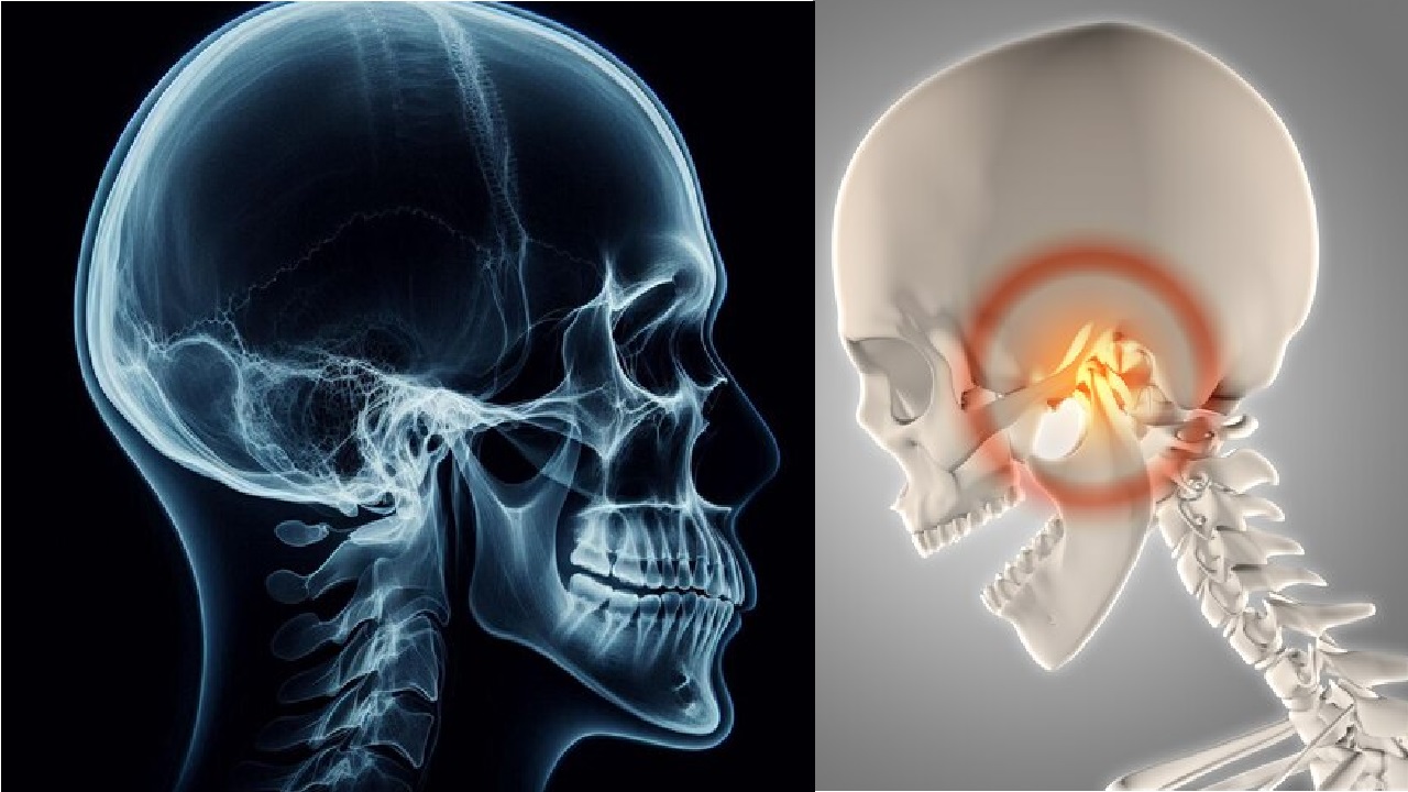 Frequently Asked Questions About the Zygomatic Arch implants