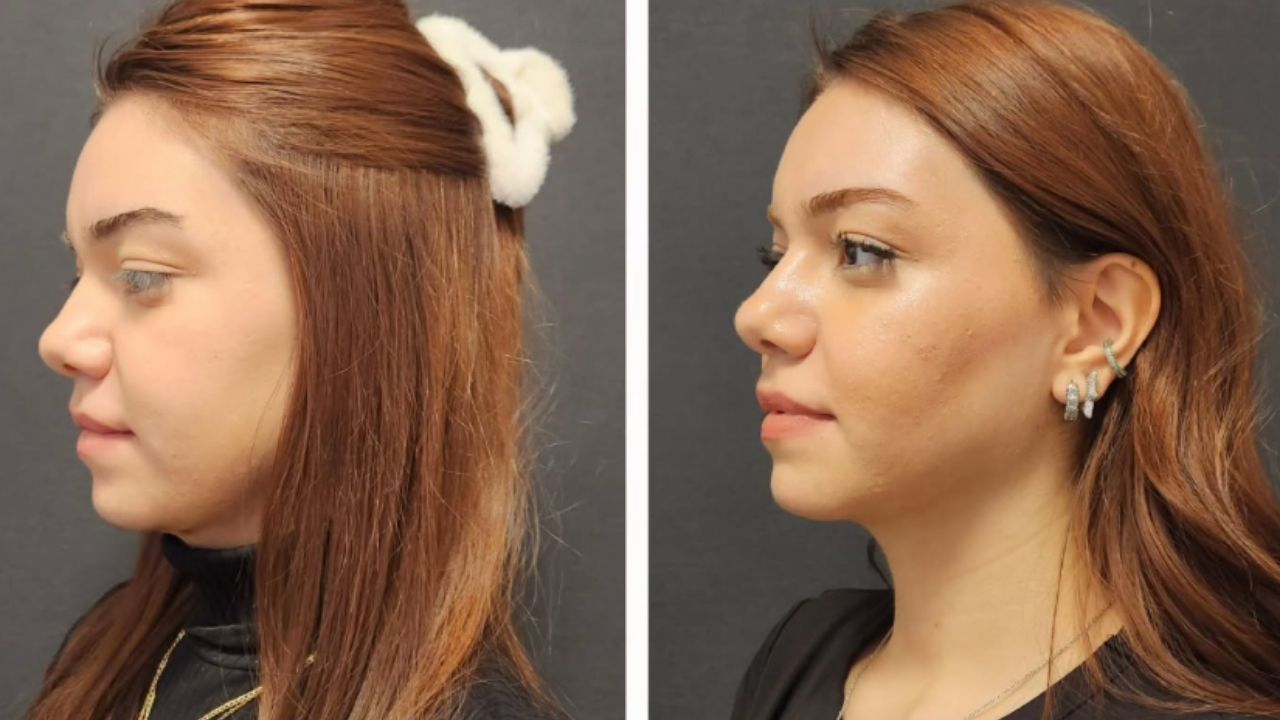 Preventing TMJ Disorder Symptoms