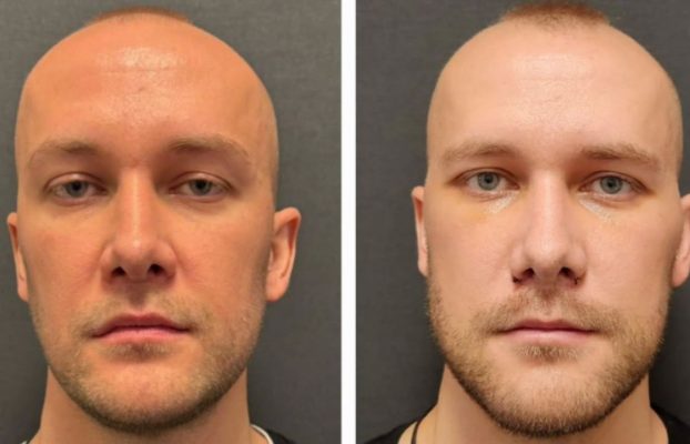 Titanium Facial Implants Before and After: A Comprehensive Guide to Facial Transformation