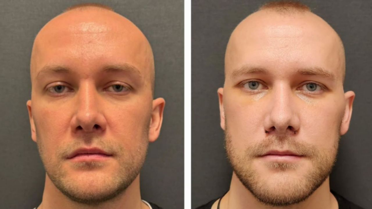 Titanium Facial Implants Before and After: A Comprehensive Guide to Facial Transformation