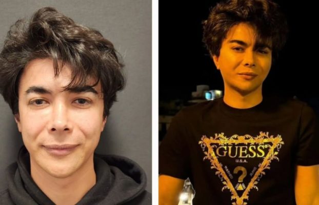 What are Zygomatic Arch implants? How to Perform?