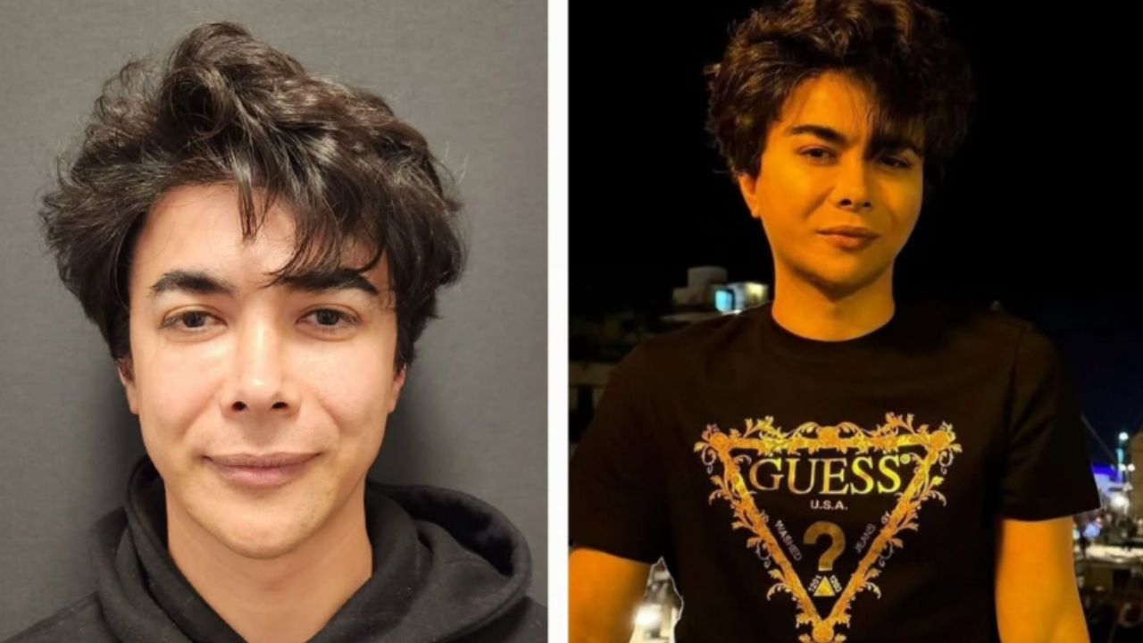 What are Zygomatic Arch implants? How to Perform?