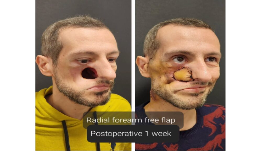Zygomatic Arch İmplants Before and After